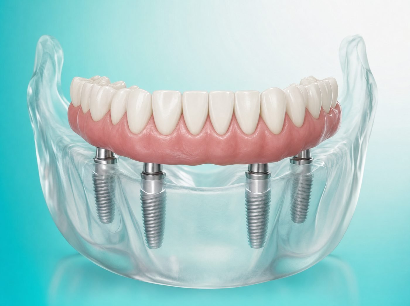 Dentadura fija sujeta sobre cuatro implantes
