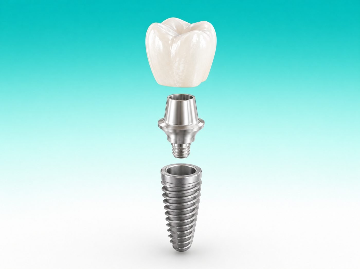 Partes de un implante dental: tornillo de titanio, pieza de unión y corona